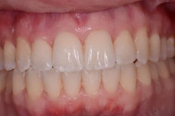Invisalign After
