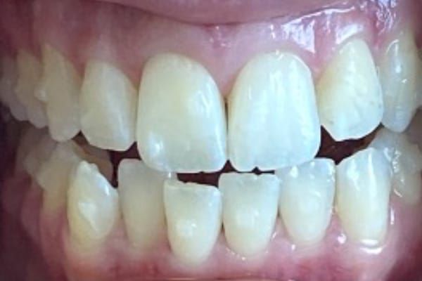 Invisalign Before