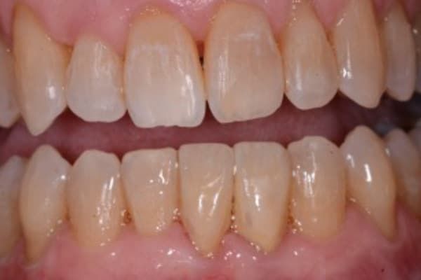 Invisalign After