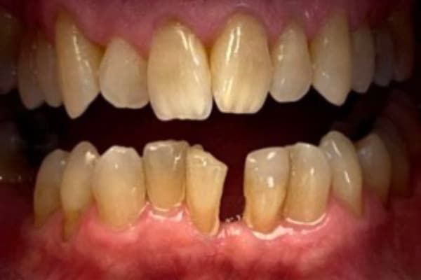 Invisalign Before
