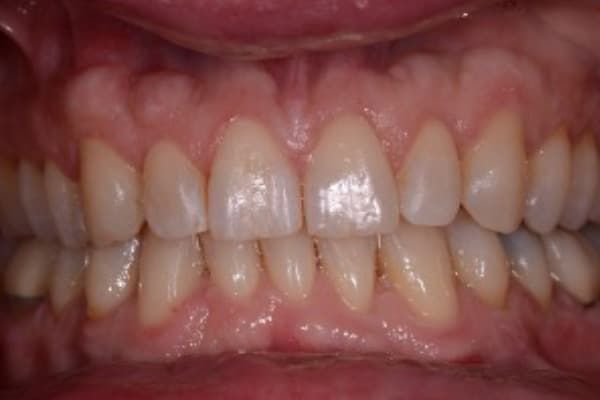 Invisalign After