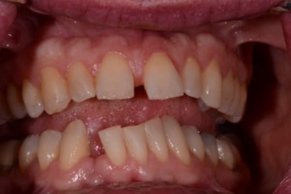 Invisalign Before