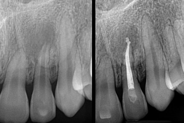 Endodontics Before & After