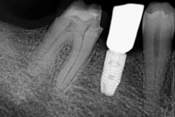Endodontics Before
