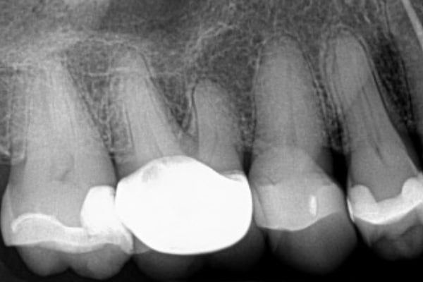 Endodontics Before & After