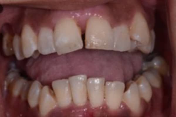 Full Invisalign Case 1