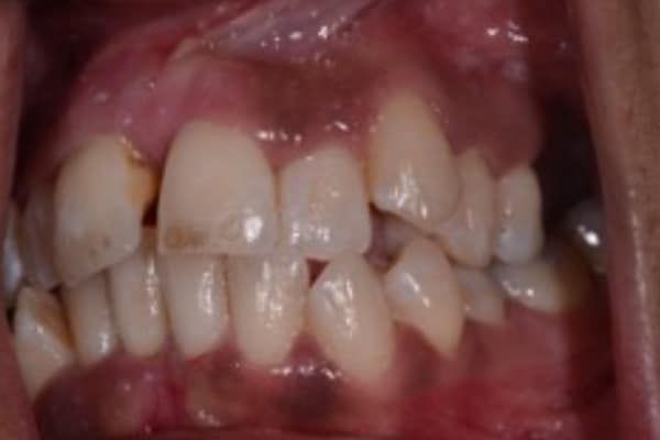 Full Invisalign Case 2