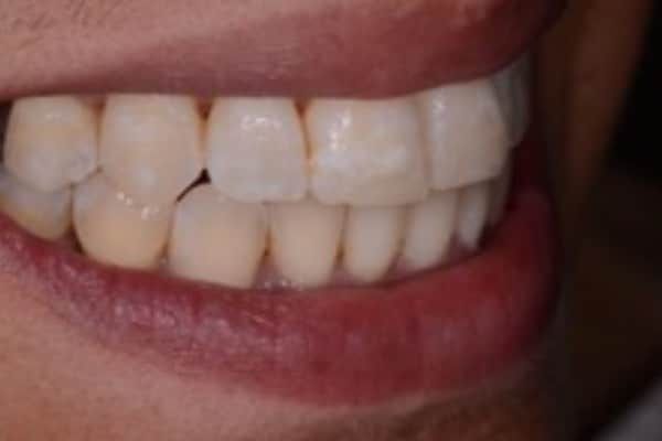 Full Invisalign Case 4