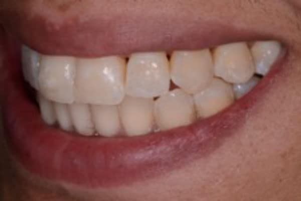 Full Invisalign Case 5