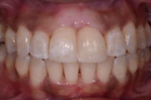 Full Invisalign Case 3