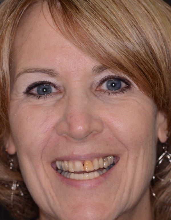 Before Smile Makeover