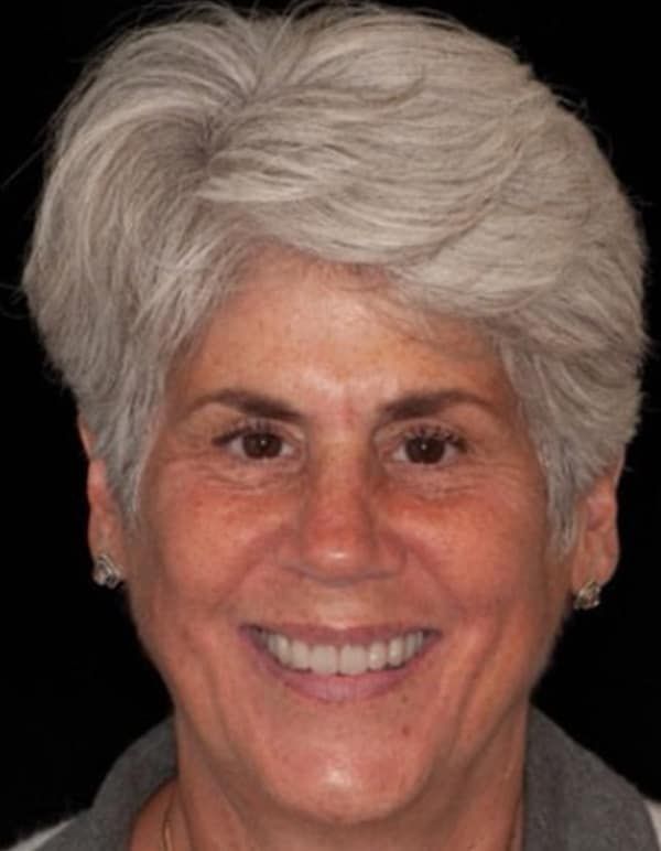 After Smile Makeover