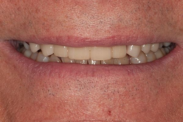 Dentures After