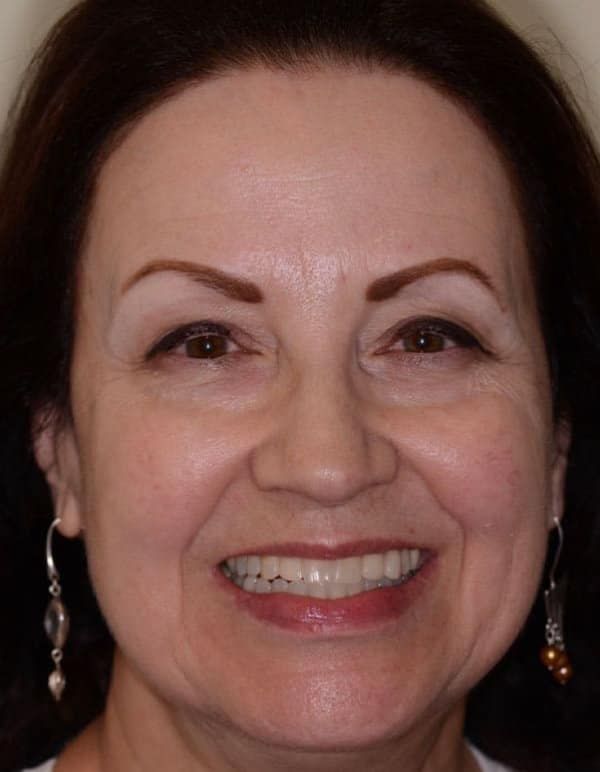 After Smile Makeover