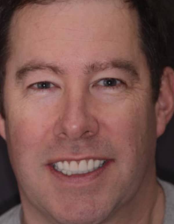 After Smile Makeover