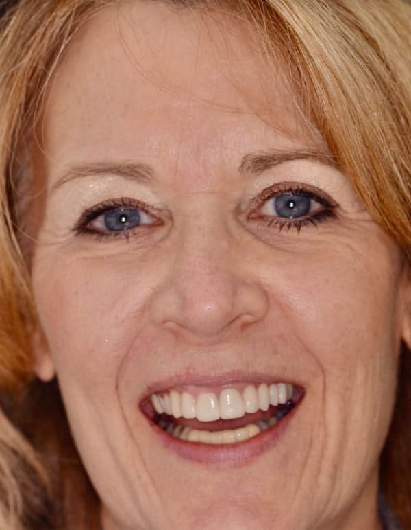 After Smile Makeover