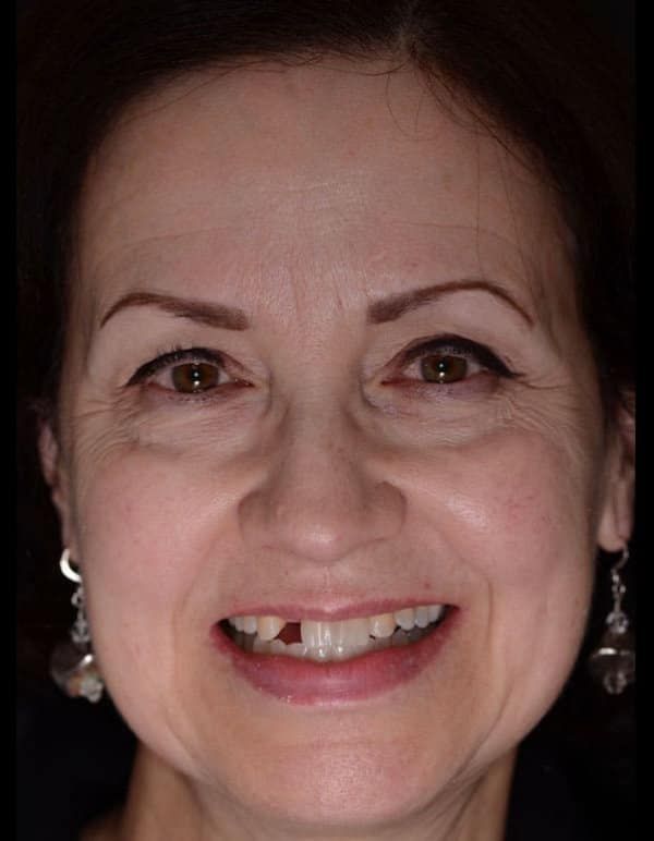 Before Smile Makeover