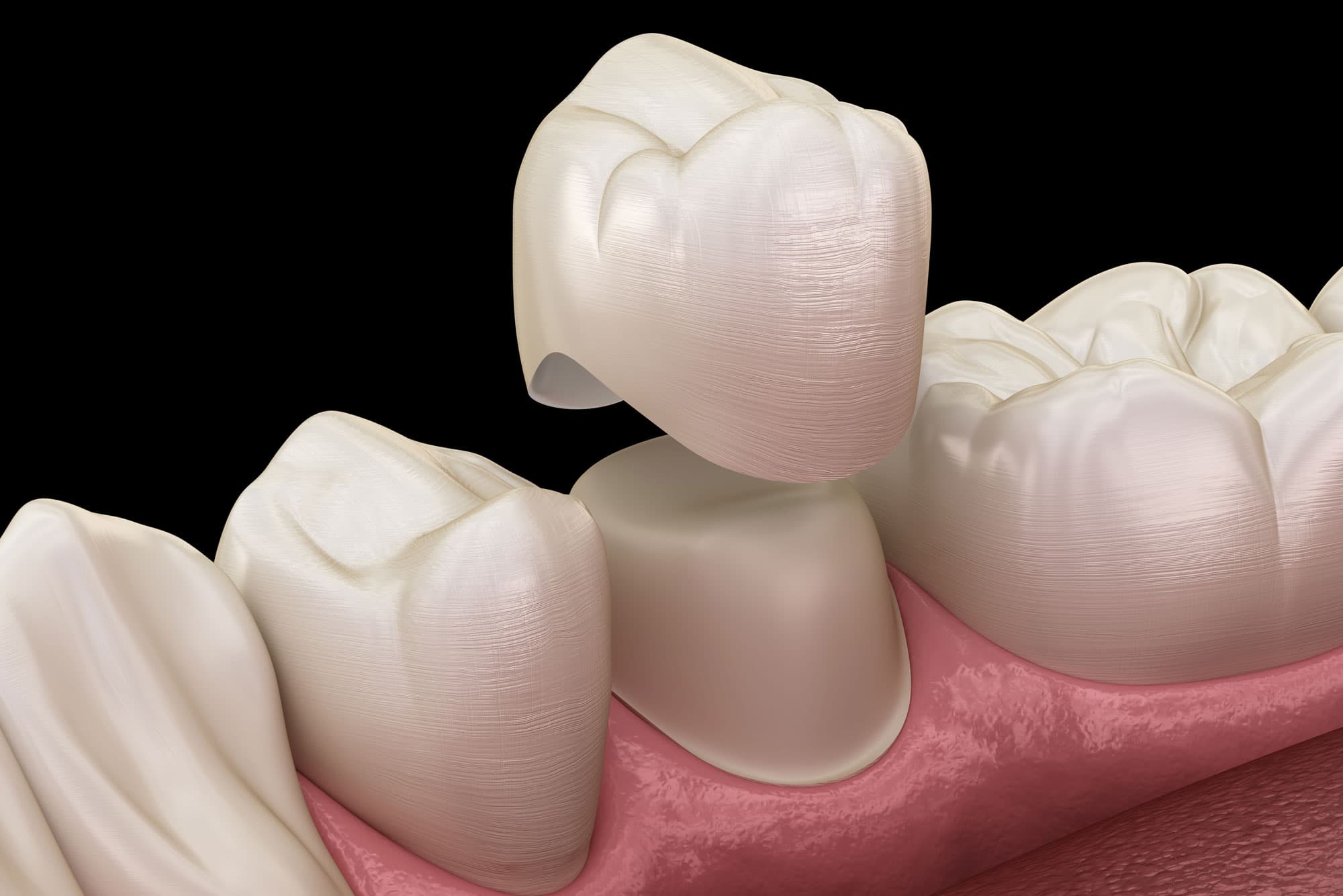 dental crowns sculpture