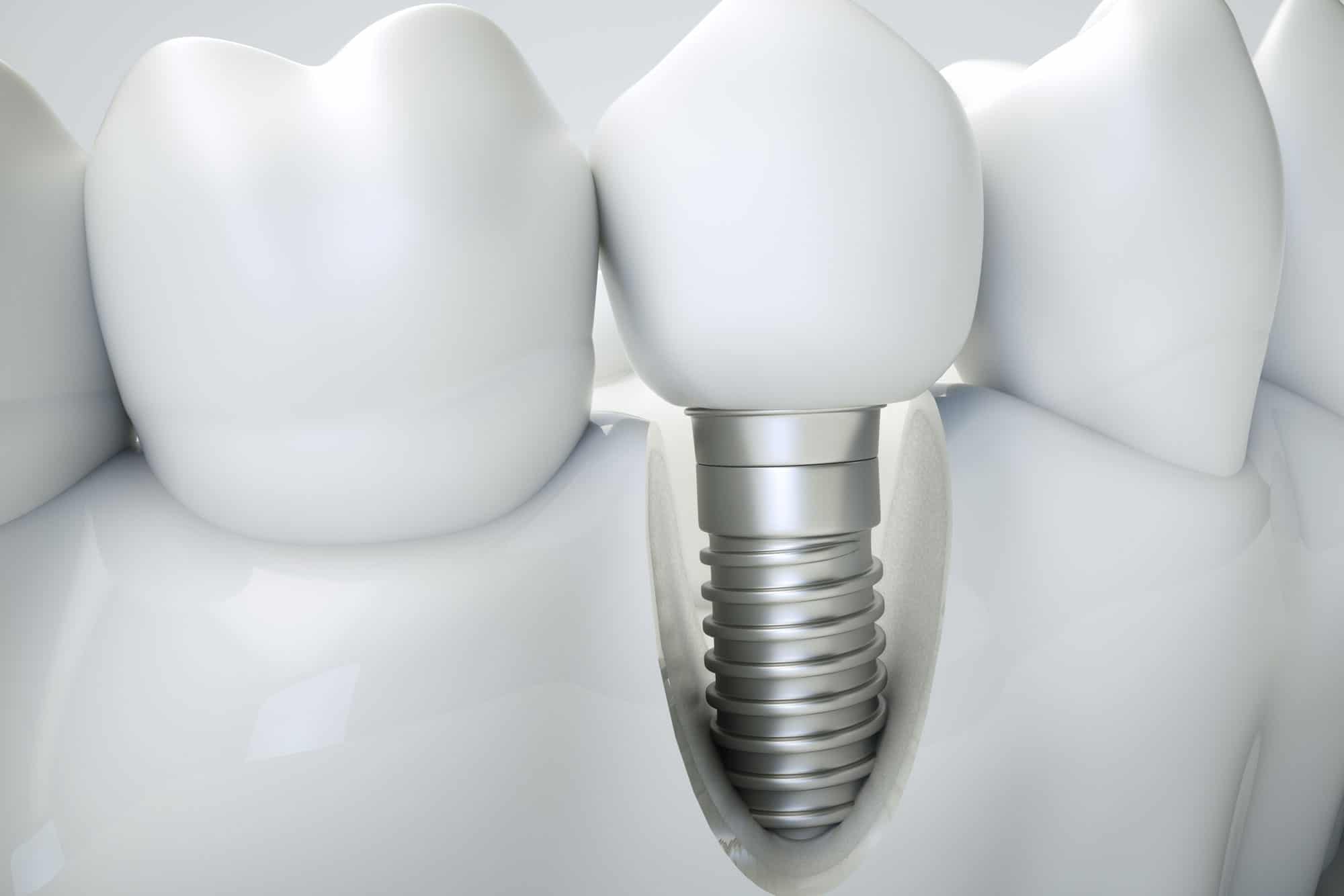 implant uncovering