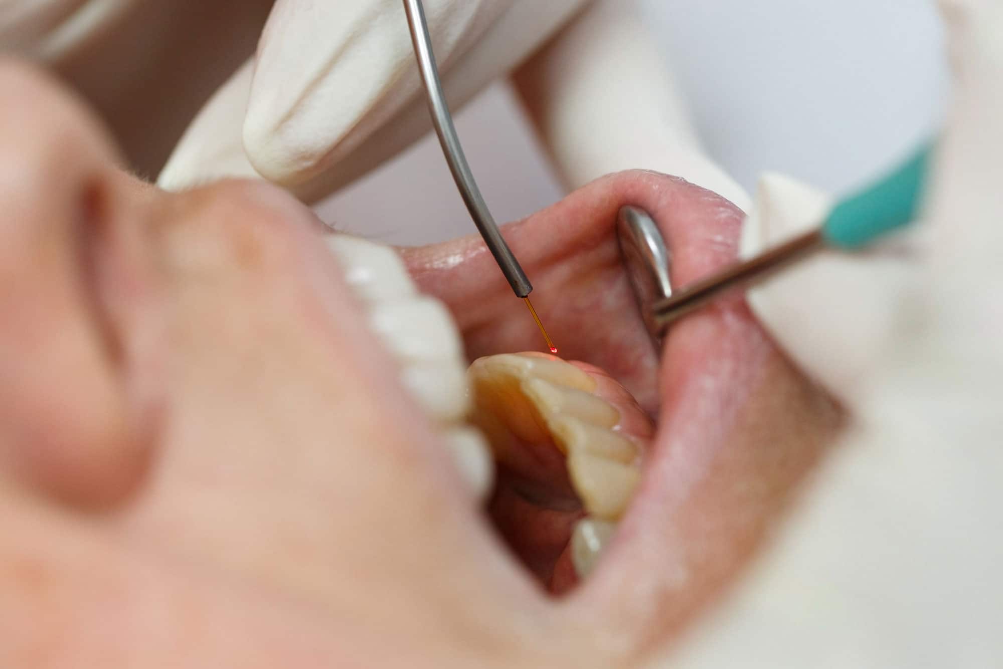 laser biopsies