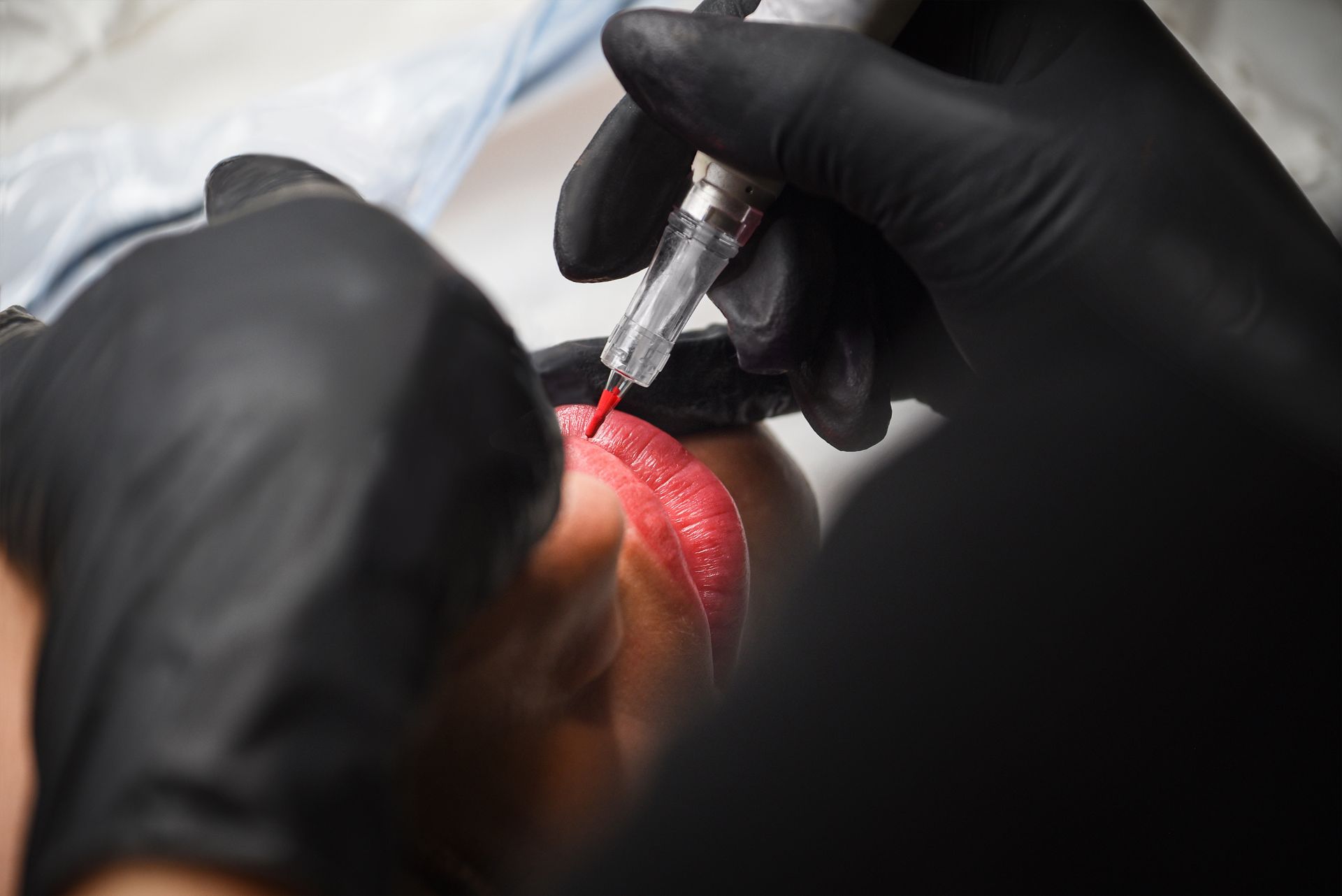 Gloved hands using a syringe to inject a red, glowing area on skin close-up
