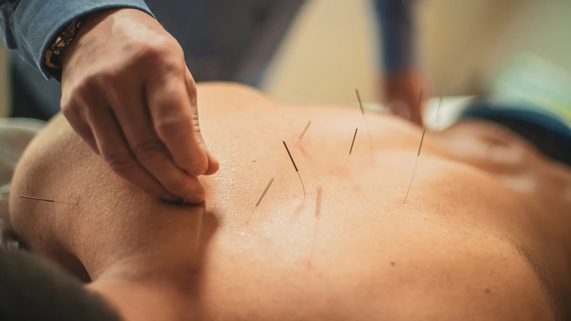 Hand placing acupuncture needles into a person's bare back during a treatment session