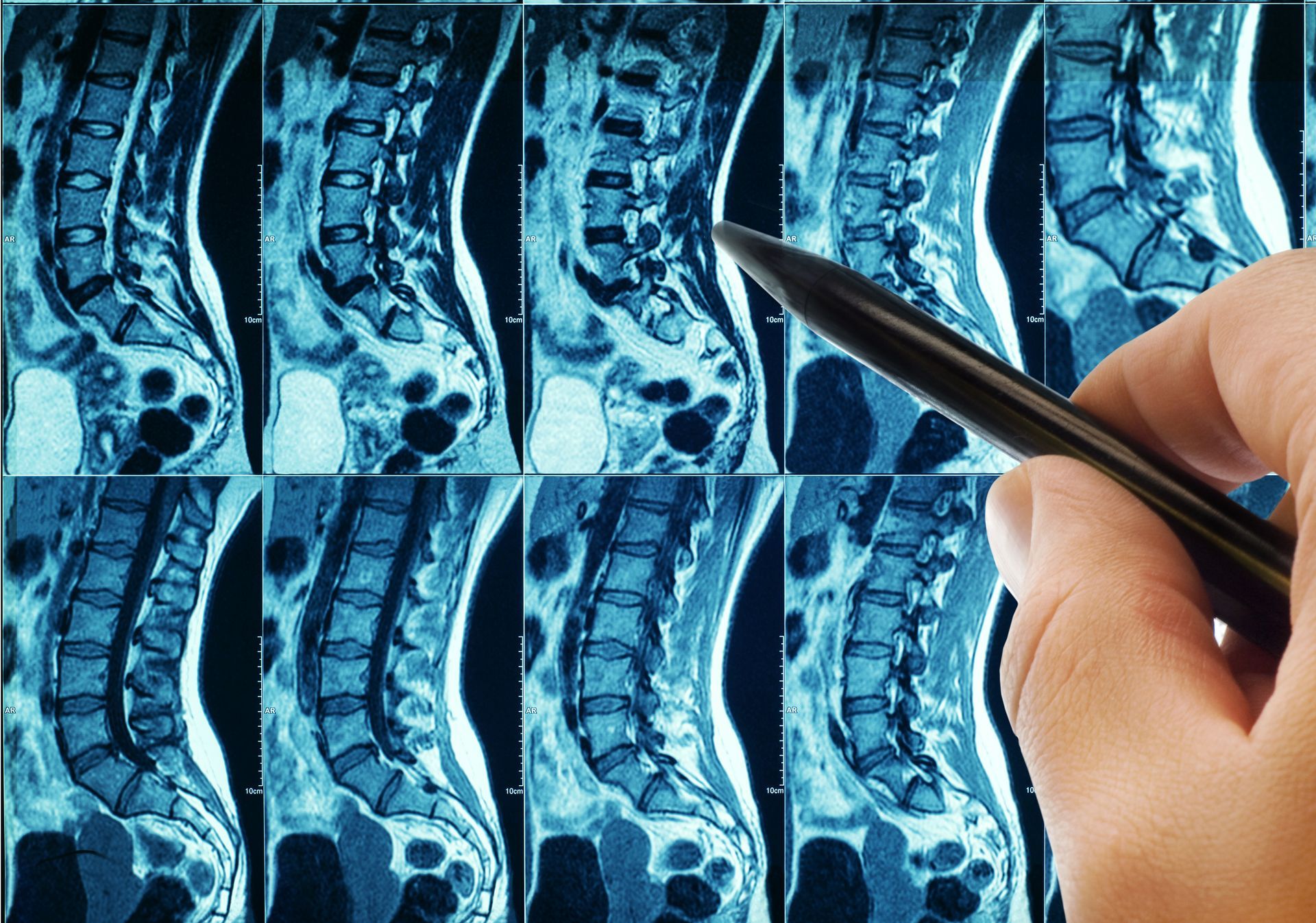 A hand uses a pen to point at a series of spinal MRI scans.