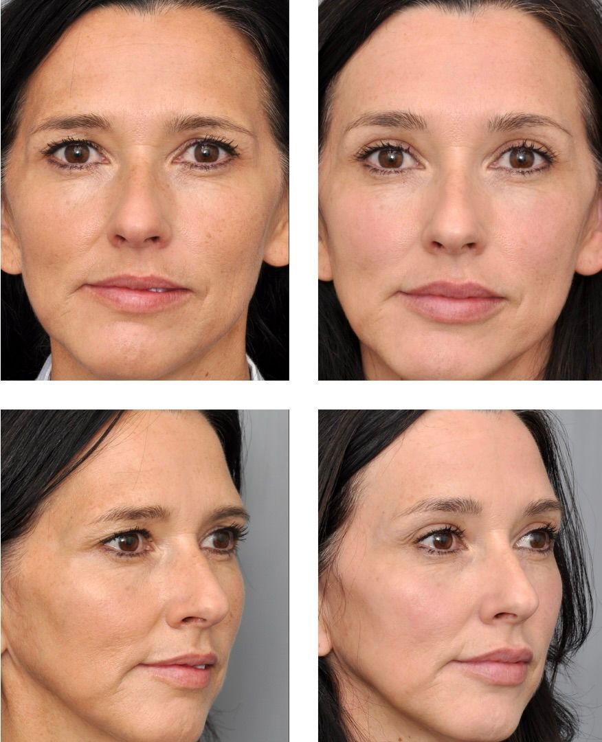 Side-by-side before-and-after facial rejuvenation photos. Reduced wrinkles and smoother skin are visible.