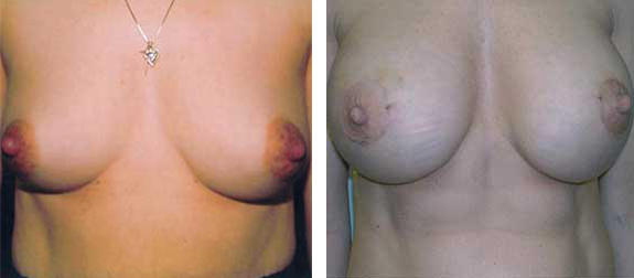 Before and after comparison of breasts, likely post-surgery.