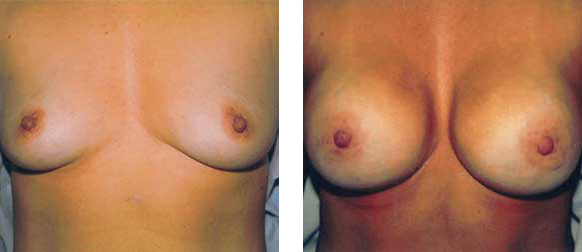Two side-by-side images of a person's chest. Left image shows smaller breasts, right image shows larger breasts.