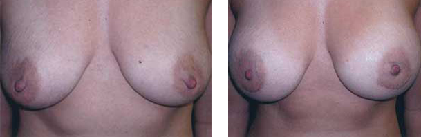 Two breasts side-by-side, one pair droopier than the other. Both have pink nipples.