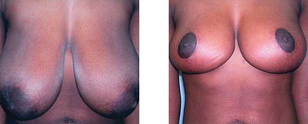 Two views of breasts before and after treatment, showing changes in shape and appearance.