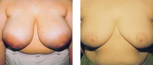 Two views of a person's chest, before and after a surgical procedure.