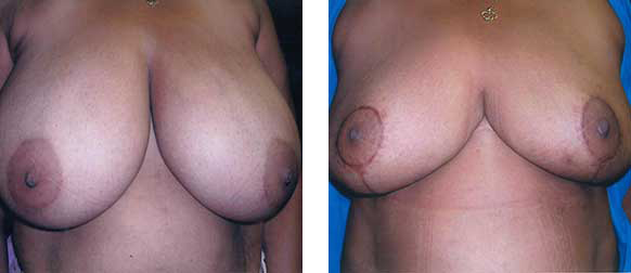 Two sets of female breasts before and after a cosmetic procedure, viewed from the front. Skin is pale.