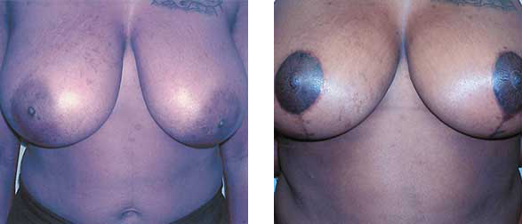 Two views of a person's chest, showing breasts with different nipple colors and skin tones.