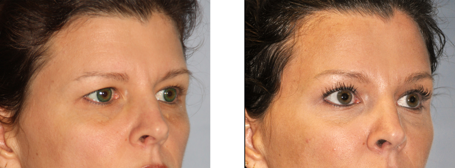 Before and after comparison of a woman's face, showing a smoother brow area on the right.