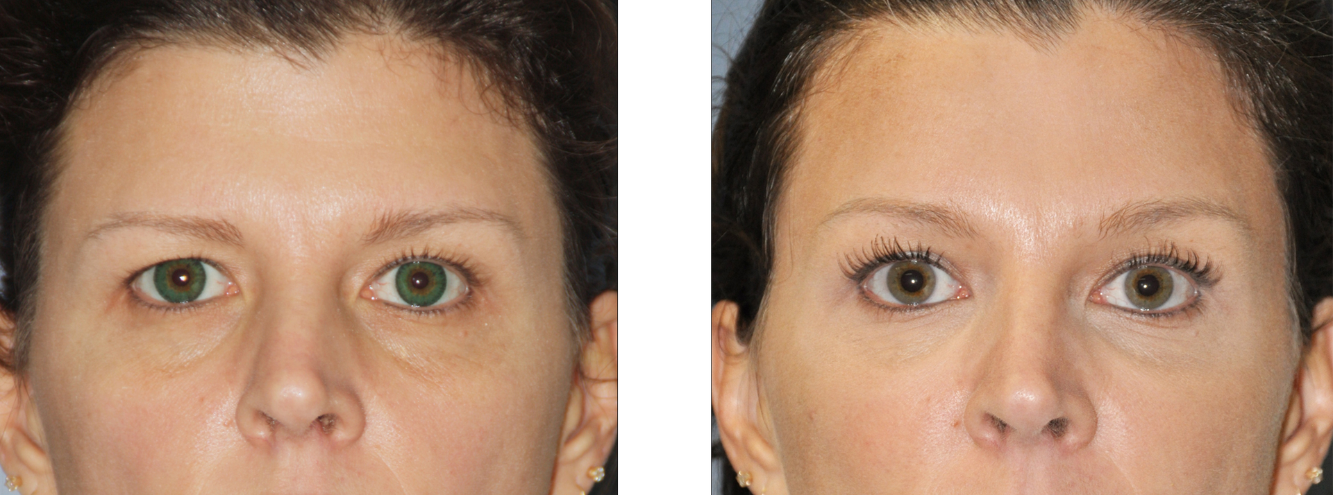 Before and after comparison of eyes after a cosmetic procedure.
