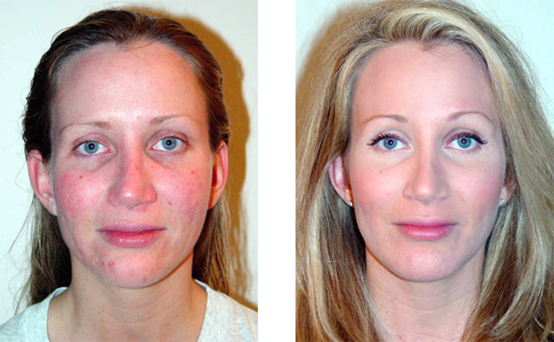 Side-by-side comparison: woman's face showing skin redness on left, improved complexion and makeup on right.