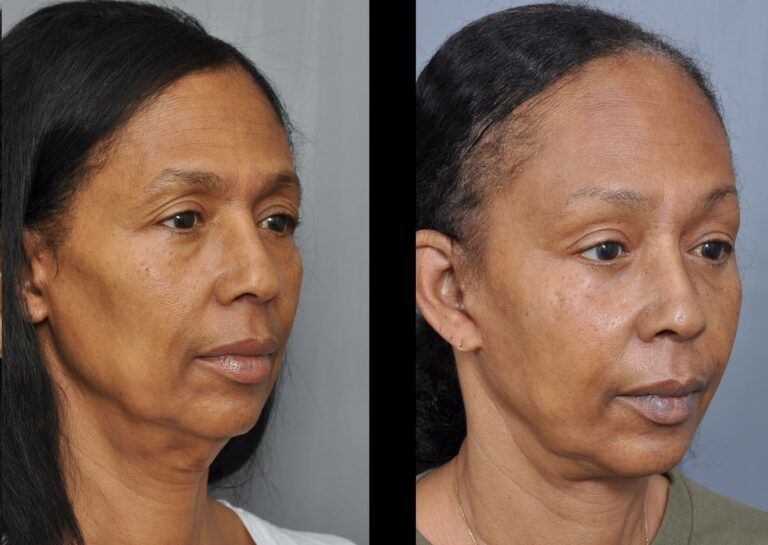 Williamson Cosmetic Center - fat grafting gallery