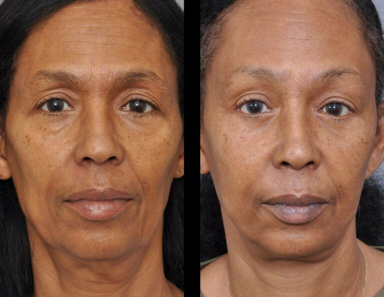 Before and after facial view showing reduced wrinkles and smoother skin.