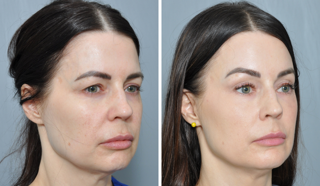 Before and after photos showing a woman's face. The 