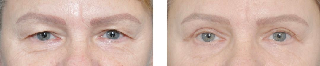 Williamson Cosmetic Center - upper bleph gallery
