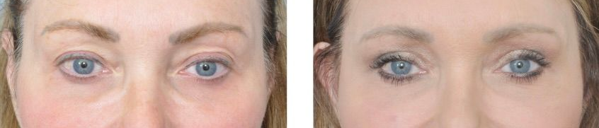 Before and after photos showing a woman's face, frontal and profile views, likely after cosmetic surgery.