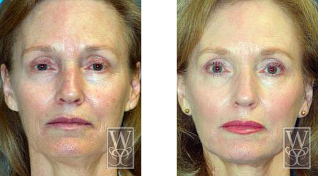 Williamson Cosmetic Center - chemical peel gallery