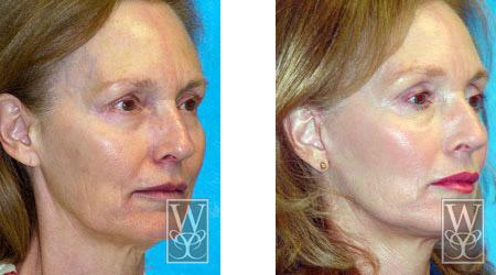 Before and after photos of a woman's face, showing a facelift. The 