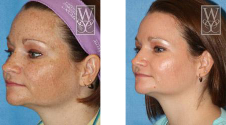 Side-by-side view of a woman's face before and after a skin treatment, showing reduced pigmentation.