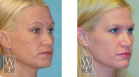 Side-by-side photos of a woman's face, showing a skin transformation, likely a cosmetic procedure.