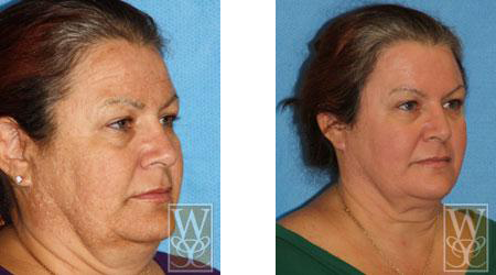 Before and after photos of a person's face after a cosmetic procedure, with reduced wrinkles.