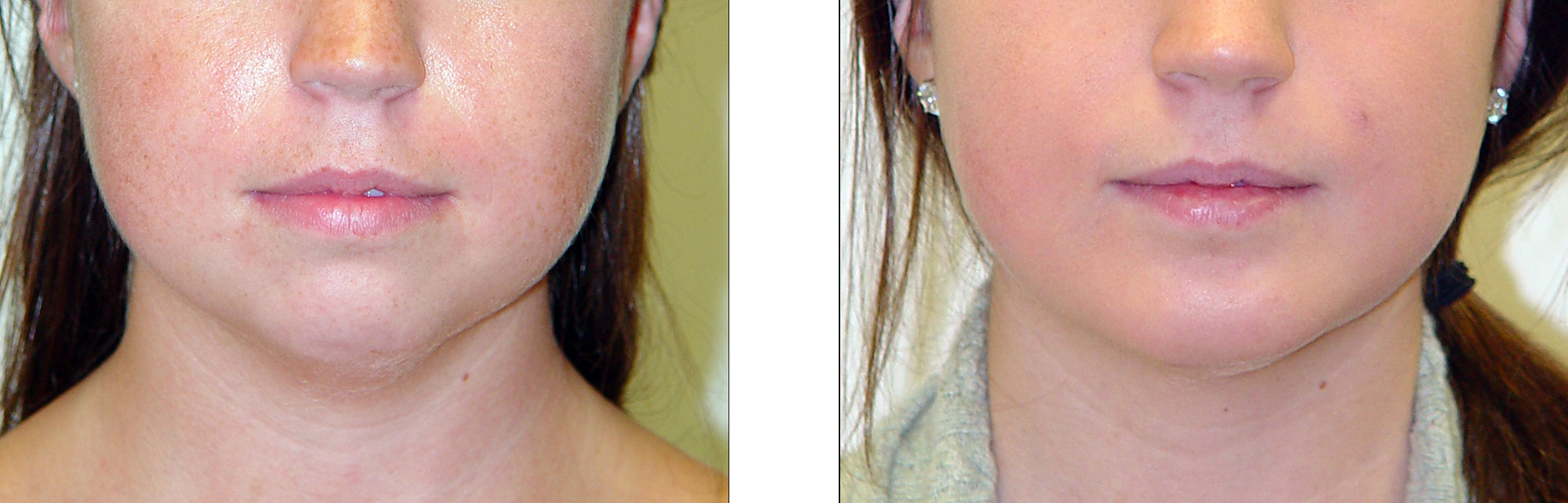 Before and after comparison of a person's face; visible jawline difference.