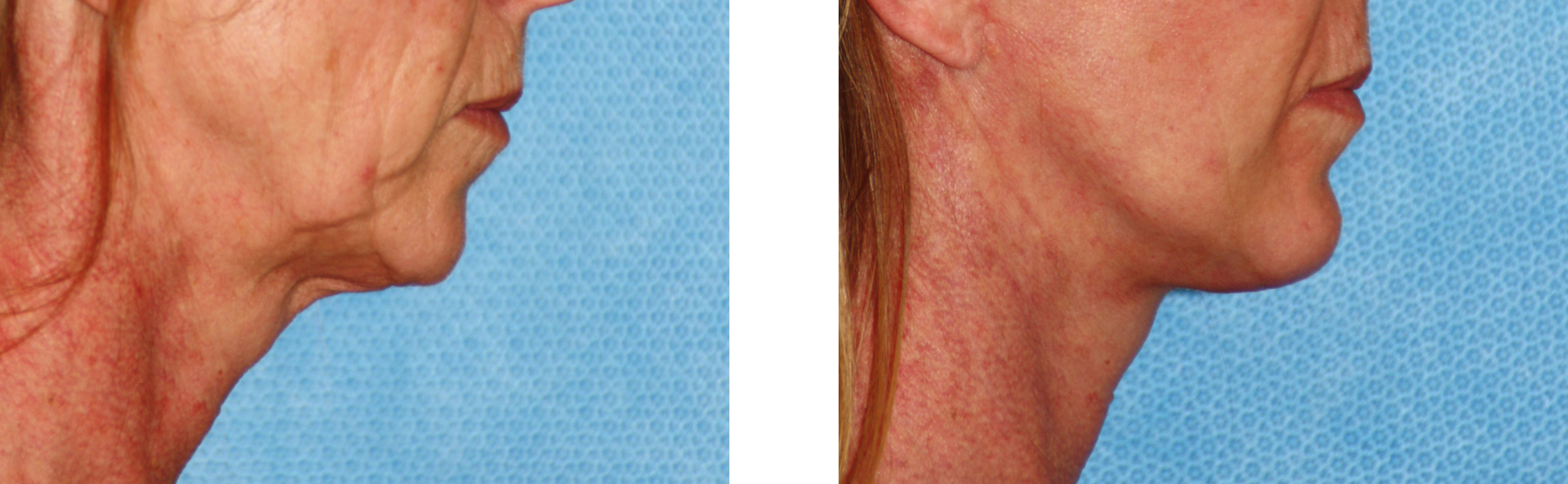 Before and after photos of a neck lift; wrinkled skin on the left, smooth skin on the right.